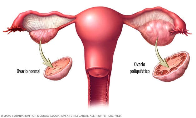 Síndrome de Ovario Poliquístico en primera persona - Conasi